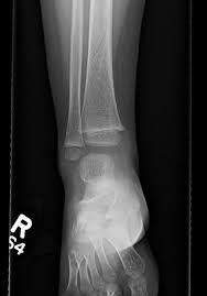 Spiral fracture — deform 04:49. A Toddler S Tibia Common Yet Obscure Brown Emergency Medicine