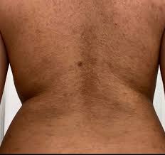 By the end of a week, sheets and pillowcases are swarming with dead skin cells and bacteria. Acne What Is The Best Way To Get Rid Of My Back Acne Scars And Make It Look Smoother Skincareaddiction
