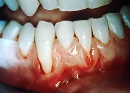 Image result for gums cancer symptoms