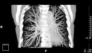 As a ct scan detects abnormal tissue, it is useful for planning areas for radiotherapy and biopsies. How Good Is A Ct Scan At Detecting Cancer Ct Scan Machine