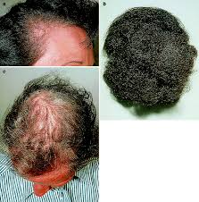 Many different factors contribute to this condition, including certain medications. Examining Hair Loss In Women Springerlink