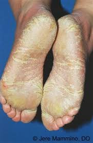 Drugs used to treat pityriasis rubra pilaris. Pityriasis Rubra Pilaris American Osteopathic College Of Dermatology Aocd