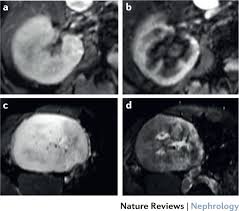 Some of them can damage patient's kidney function gradually, which will lead to kidney failure eventually, and they are. Radiologic Imaging Of The Renal Parenchyma Structure And Function Nature Reviews Nephrology