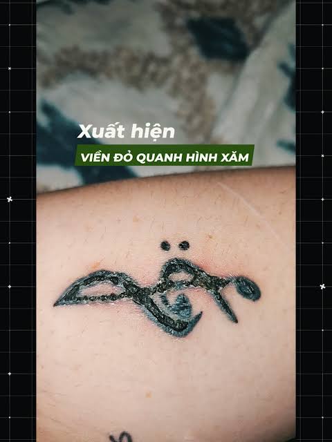 Hình ảnh minh họa vùng da bị nhiễm trùng nghiêm trọng sau khi xăm với biểu hiện viêm đỏ và mủ