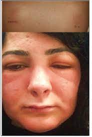 Allergic Contact Dermatitis To Clindamycin And Benzoyl Peroxide Resembling Urticaria Angioedema Biomedres
