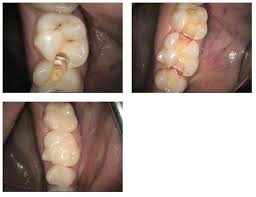 Your dentist may use a fluoride gel or varnish to reverse the early stage of dental caries. Filling Success Gilbert Smiles