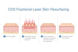 Image result for Laser Skin Procedure