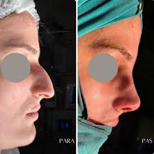 Otoplasty (Pa operacion).