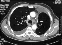 A ct scan can help doctors find cancer and show things like a tumor's shape and size. Computed Tomography In Staging For Lung Cancer European Respiratory Society