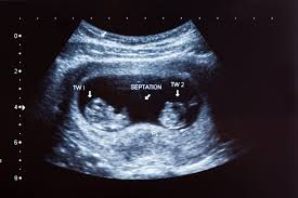 Pin On Pregnancy Ultrasounds And Tips
