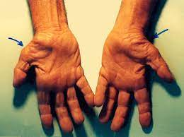 Carpal tunnel syndrome (cts) is a peripheral neuropathy caused by chronic or acute compression of the median nerve by the transverse carpal ligament. Carpal Tunnel Syndrome Wikipedia