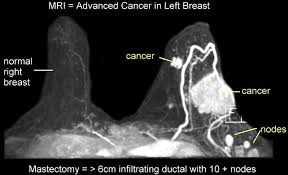 These symptoms can look and feel like infection or for other breast cancers, surgery is typically done first. Inflammatory Breast Cancer Mri Pictures Cancerwalls