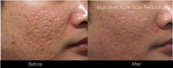 Treatment for acne scarring is considered cosmetic and is not a medical treatment. Acne Scar Treatment In Toronto Spamedica