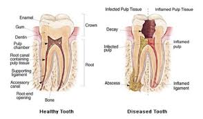 Root Canal Treatment
