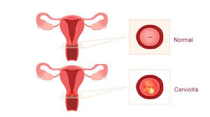 Que Es La Cervicitis Sintomas Causas Y Como Tratar La Enfermedad
