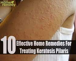 Home Remedies For Getting Relief From Keratosis Pilaris Treat Keratosis Pilaris Keratosis Pilaris Pimples Remedies