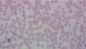 Image result for Peripheral Smear