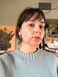 According to dermatologist debra jaliman, m.d., accutane is a derivative of vitamin a that patients take orally (often twice a day). Arden Rose On Twitter Doing An Ama For My Acne Accutane Journey If You Have Any Questions You D Like Answered In My Next Video Ask Me Errthang And Anythang Https T Co Osvzr1kms2