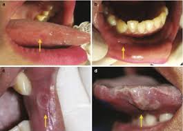 Image result for syphilis ulcer