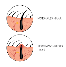 hilfe bei rasurbrand eingewachsenen haaren follikulitis laseraesthetik berlin mitte