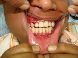 It's important to take gingivitis seriously and treat it promptly. The Confusion On What Gingivitis If And What Causes It