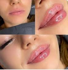 12 Lip fillers ideas