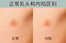 正常乳头和内陷区别照片_39健康网