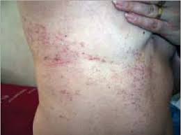 Prevenirea apariției bolii numite zona zoster pentru a preveni zona zoster persoanele în vârstă de peste 50 de ani pot fi vaccinate cu un vaccin numit zostavax, care reduce cu 50% riscul apariției zonei zoster. Figure 1 From Lichen Plan Localizat Zona Zoster Like Lichen Planus Localized Herpes Zoster Like Semantic Scholar