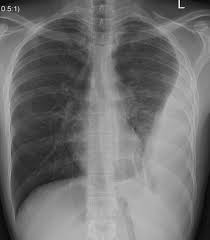 Most commonly caused by a viral infection. Pleural Imaging Radiology Key