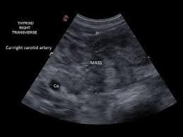 Several types of thyroid cancer exist. Canine Thyroid Carcinoma Minnesota Veterinary Ultrasound