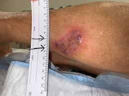 Image result for Pyoderma Gangrenosum