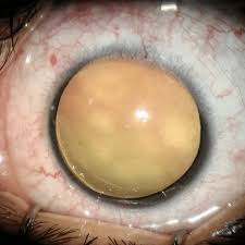 Check spelling or type a new query. Ectropion Uvea With Fixed Dilated Pupil Download Scientific Diagram