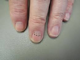 These are known as mees' lines or transverse leukonychia. Polydactylous Transverse Erythronychia Report Of A Patient With Multiple Horizontal Red Bands Affecting The Fingernails Springerlink