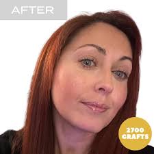 Female Hair Transplant NYC by Nova Medical Hair Transplant