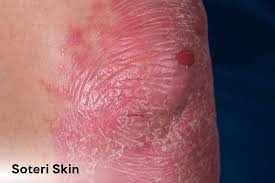 Image result for Auspitz Sign