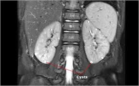 Astepaway New Search Experience Kidney Cyst Cysts Kidney