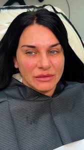 ✨ Can we take a moment to appreciate how fresh, glowing, and radiant our  gorgeous client looks? ✨, She’s had:, 💉 3 areas of anti-wrinkle treatment,  🌟 Lumi Pro skin booster, ✨ Our signature technique ...