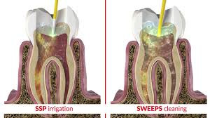 What to expect immediately after a root canal although a root canal ultimately means less pain, in the immediate aftermath of the procedure, you'll likely feel some tenderness. Sweeps Laser Assisted Root Canal Treatment Youtube