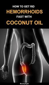 How To Get Rid Of Hemorrhoids Fast With Coconut Oil Getting Rid Of Hemorrhoids Coconut Oil For Hemorrhoids Cure For Hemorrhoids