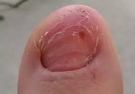 And if you lose a toenail, it can take up to a year and a half for it to completely grow. Toenails After Complete Loss Of A Toe Nail How Can I Prevent It Growing Back Ingrown Quora