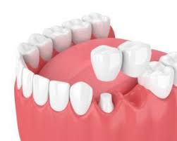 The dentist will remove some of the enamel and dentin from the abutment teeth to make space for the crowns. The 4 Types Of Dental Bridges
