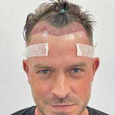 Ashley Taylor Dawson the latests Hollyoaks star to visit the British Hair  Clinic
