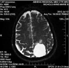 Pin On I Had A Brain Tumor