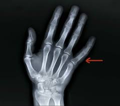 Image result for Hand Fracture