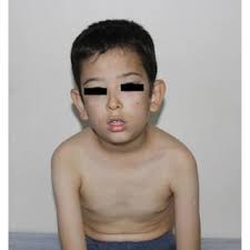 a) The boy, before carnitine treatment with significant mask face and...