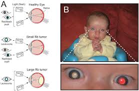 Leukocoria In Children With Retinoblastoma A The Reflection Of Download Scientific Diagram