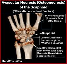 Image result for Scaphoid Bone