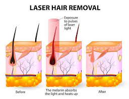 Laser hair removal procedure takes less time as compared to other procedures. What Are The Advantages And Disadvantages Of Laser Hair Removal Diethics Com