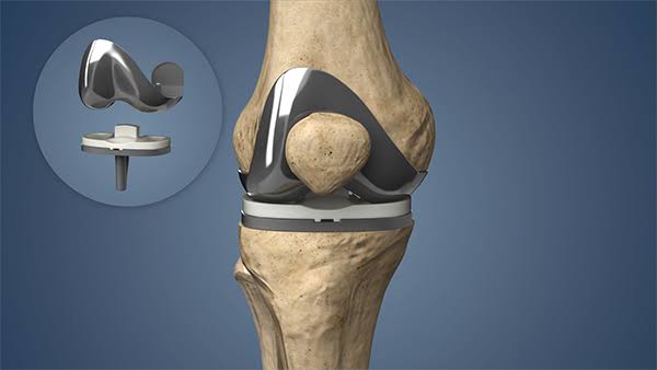 Total Joint Replacement