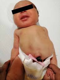 Spondyloepiphyseal Dysplasia Congenita: A Rare Cause of Respiratory  Distress